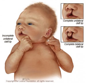 cleft-lip