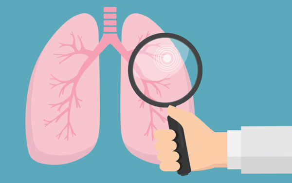 THE IMPORTANCE OF LUNG CANCER SCREENING AND SMOKING CESSATION  [Program for July 29, 2021]